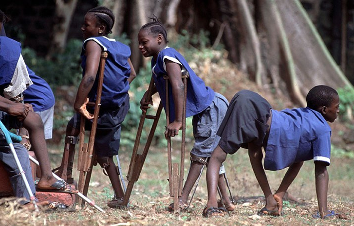 Polio